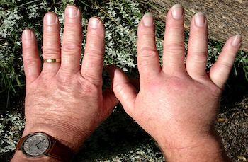 Piqûre de frelon asiatique sur main