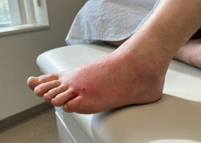 piqûre de frelon asiatique sur la jambe — réaction inflammatoire visible avec zone rosée surélevée