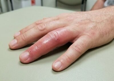 piqûre de frelon asiatique sur le doigt — gonflement important de l'index avec rougeur et œdème visible, peau tendue et brillante, réaction locale sévère après piqûre