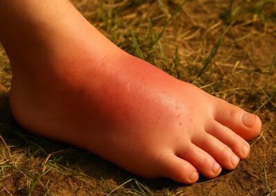 photo piqûre de frelon sur le cou-de-pied