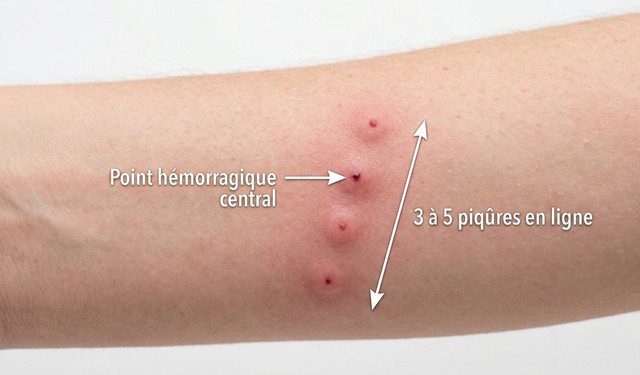 Alignement caractéristique de piqûres de punaises de lit sur avant-bras — boutons rouges en ligne avec point hémorragique central Alignement caractéristique de piqûres de punaises de lit sur avant-bras — boutons rouges en ligne avec point hémorragique central