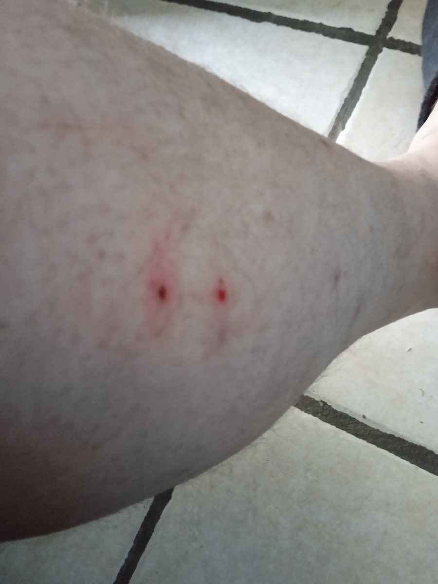 Différence piqure insecte