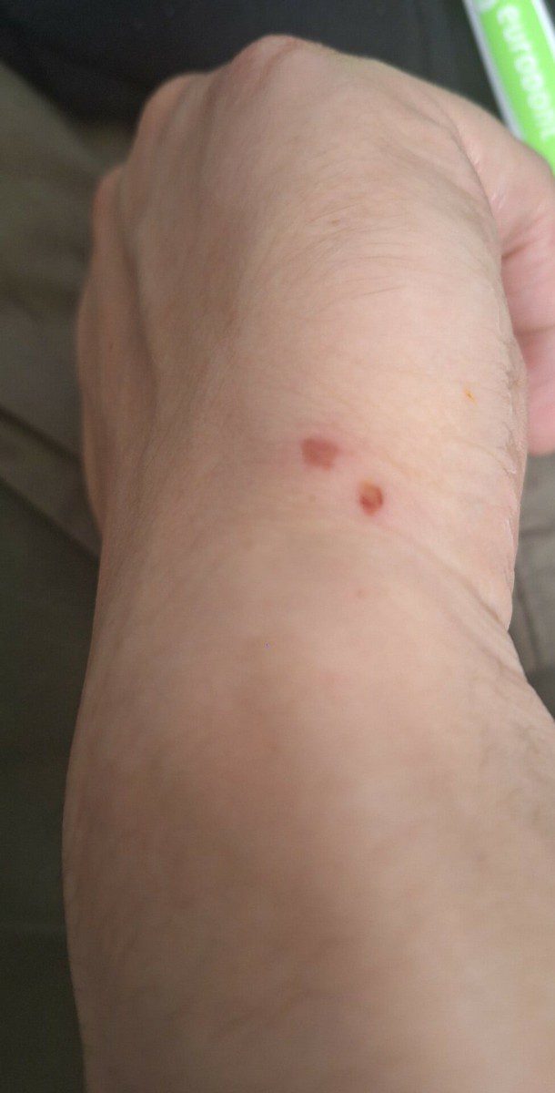 Morsure d’araignée visible sur la peau du poignet, présentant deux marques nettes côte à côte