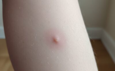 Piqûre d’araignée : comment reconnaître, traiter et éviter les risques