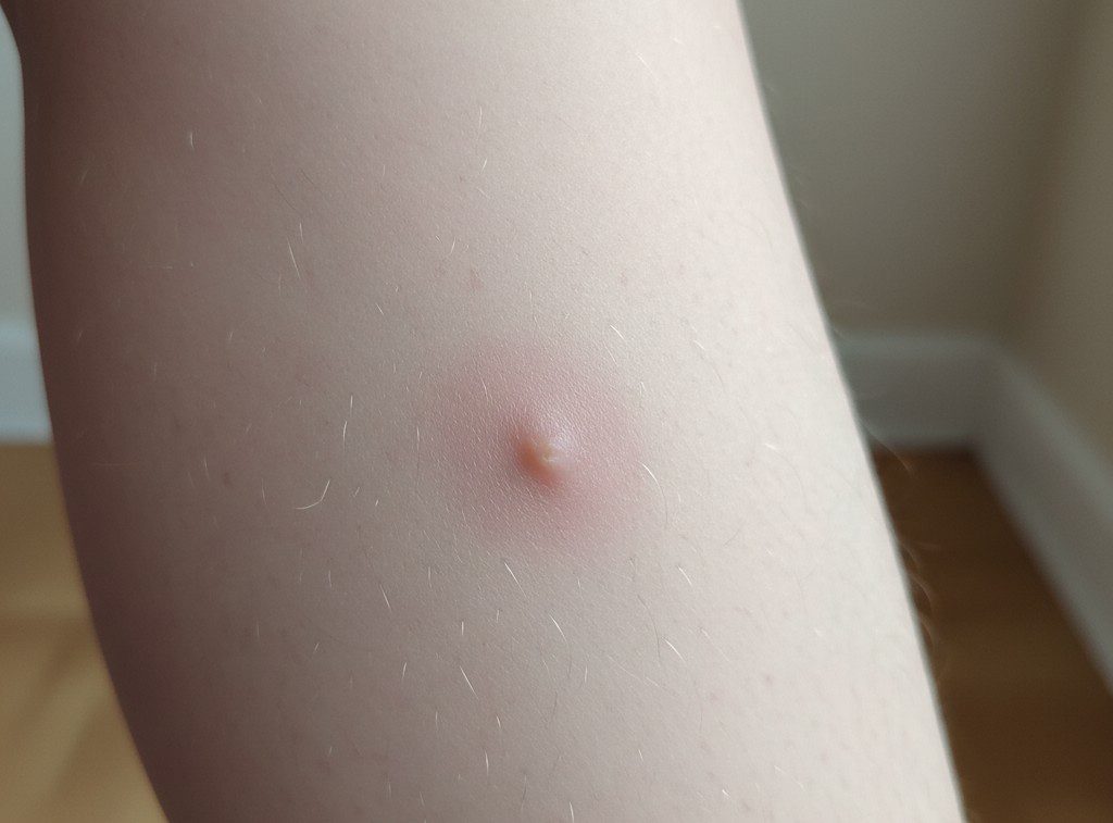 Piqûre d’araignée – comment la reconnaître et que faire vraiment Piqûre d’araignée - comment la reconnaître et que faire vraiment