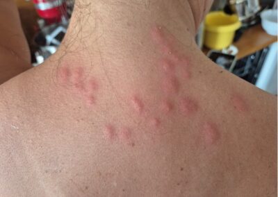 Piqûres de punaises de lit sur le haut du dos et la nuque, boutons rouges groupés en grappe avec inflammation