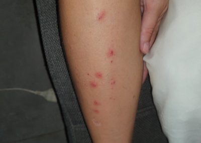 piqûres de punaise de lit sur la jambe