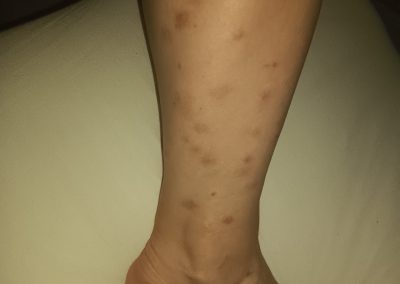 Répartition de piqûres de punaise de lit sur la jambe