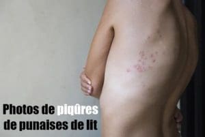 Tout sur la piqûre de punaise de lit : reconnaître les boutons (photos), symptômes, le processus, les causes, risques, et traitements pour soulager