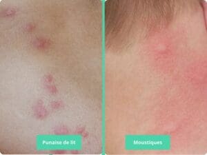Les piqûres de moustique et punaise de lit : Identifier les différences