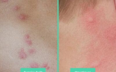 Les piqûres de moustique et punaise de lit : Identifier les différences