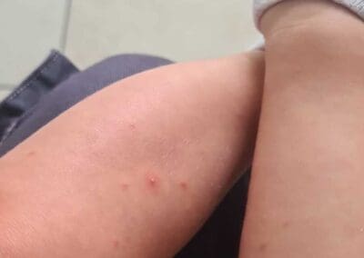 Boutons de piqûres de punaises de lit sur les pieds d'un bébé