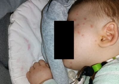 Piqûres de punaises de lit en triangle sur le visage d'un enfant