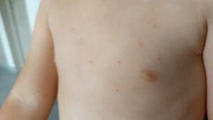 Piqûre de punaise de lit chez le bébé : Que doivent faire et ne pas faire les parents ?