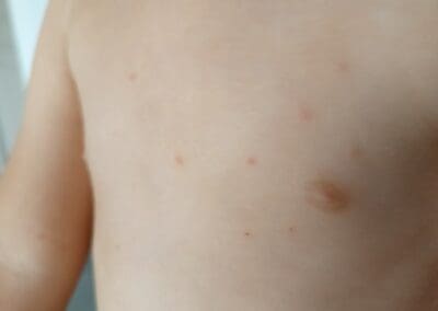 Piqures punaise de lit sur un bébé