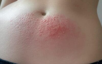 Piqûre de chenille processionnaire : Identifier et traiter efficacement