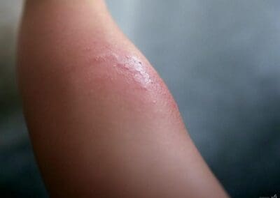 piqûre de chenille processionnaire sur le bras