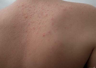 piqûre de chenille processionnaire sur le dos