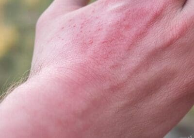 piqûres de chenille processionnaire sur une main