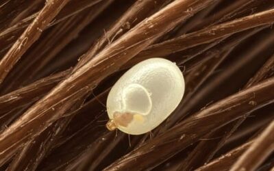 Comment reconnaître et éliminer les lentes de poux durablement ?