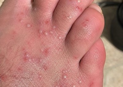 Multiples piqûres de fourmis de feu sur le pied avec pustules blanches, rougeurs et gonflement
