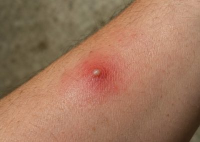 Piqûre de fourmi de feu sur avant-bras avec rougeur locale et pustule blanche centrale