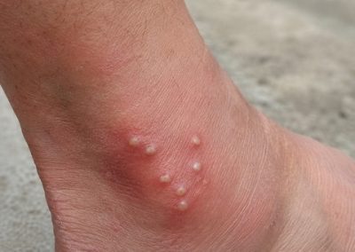 Piqûres multiples de fourmis de feu sur la cheville avec pustules blanches et inflammation