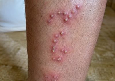 Réaction cutanée après piqûres de fourmis de feu sur la jambe avec plusieurs pustules alignées