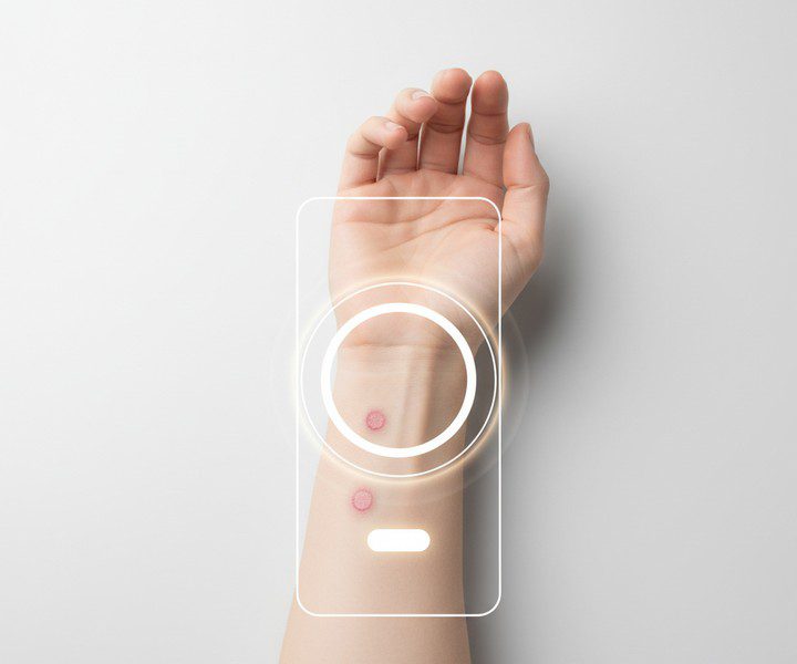 Identification d’une piqûre d’insecte