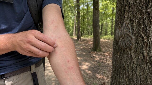 boutons rouges sur les bras boutons rouges sur les bras